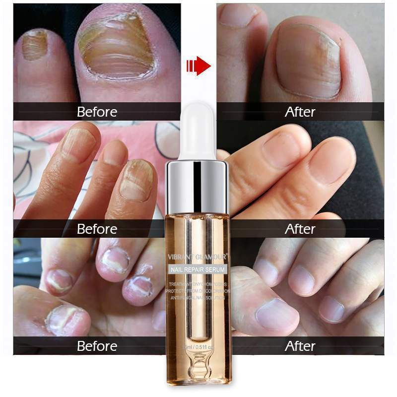 Vibrant Glamour Nail Repair Fluid Hand and Foot Nail Fungus Care Bright Nail - 2bazar4